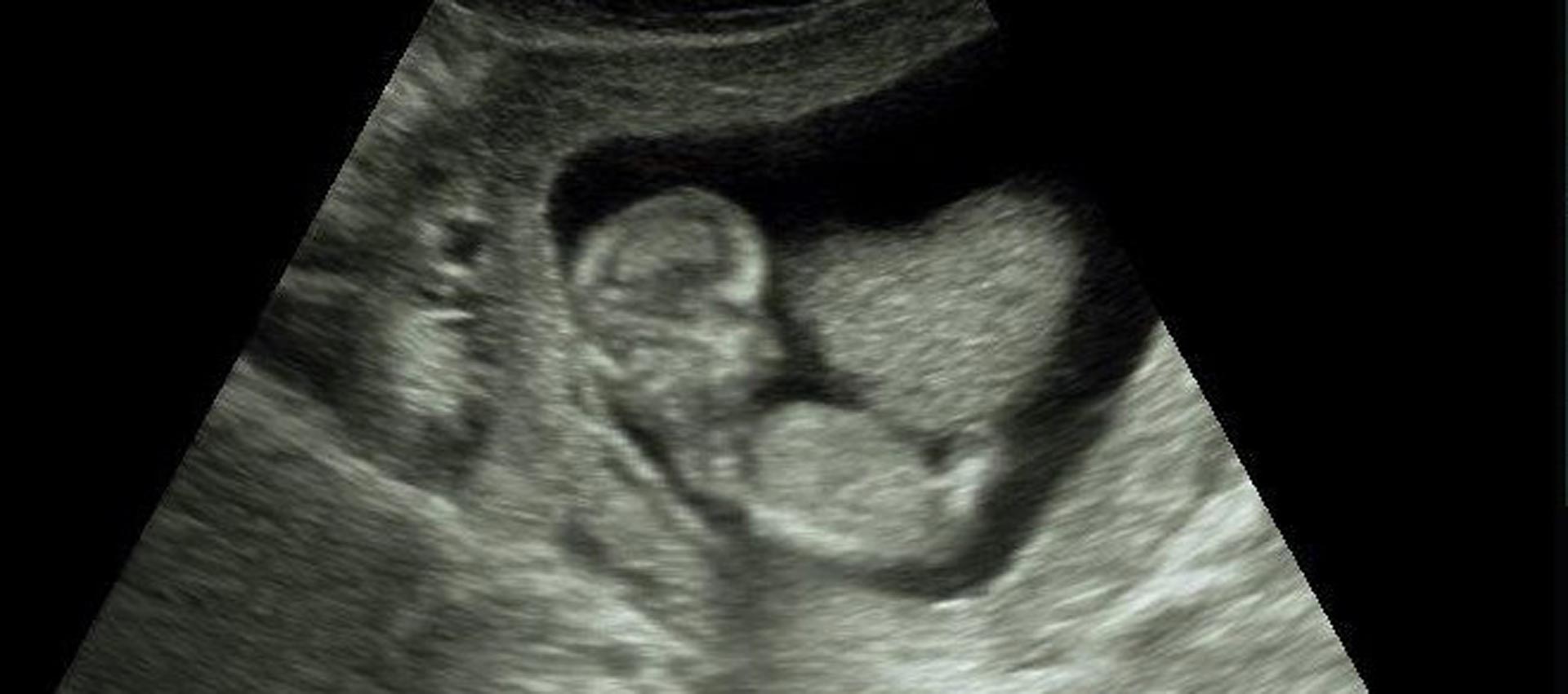 Pregnant Ultrasound